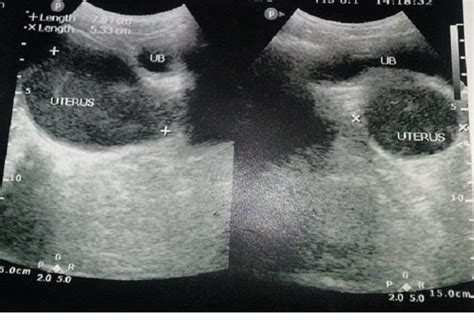 Imperforate hymen: a cause of abdominal pain in female 